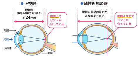 近視の説明図
